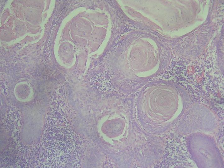 CARCINOMA EPIDEMOIDE - <div style=