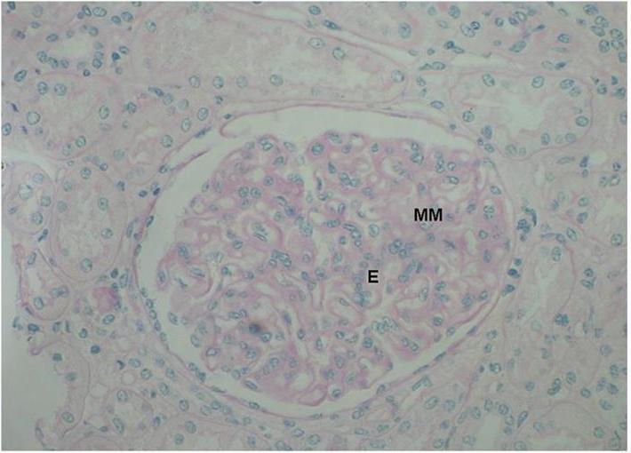 Glomerulonefritis Tipo II A . PAS 400X - <div style=