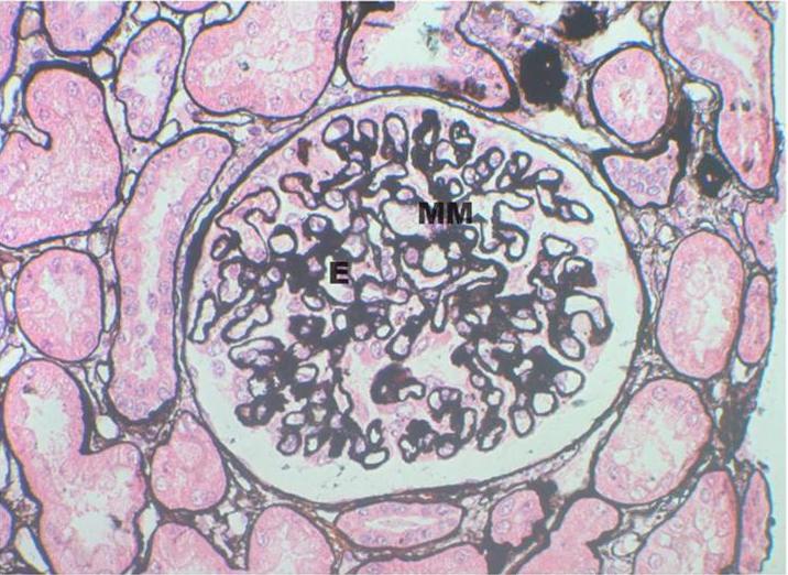 Glomerulonefritis Tipo II A. Plata-Metenamina.400X - <div style=