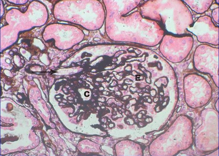 Glomerulonefritis Tipo IIIB. Plata-Metenamina.400X - <div style=