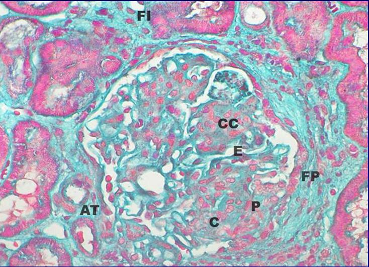 Glomerulonefritis TipoIVA.Tricrmica de Masson400X - <div style=