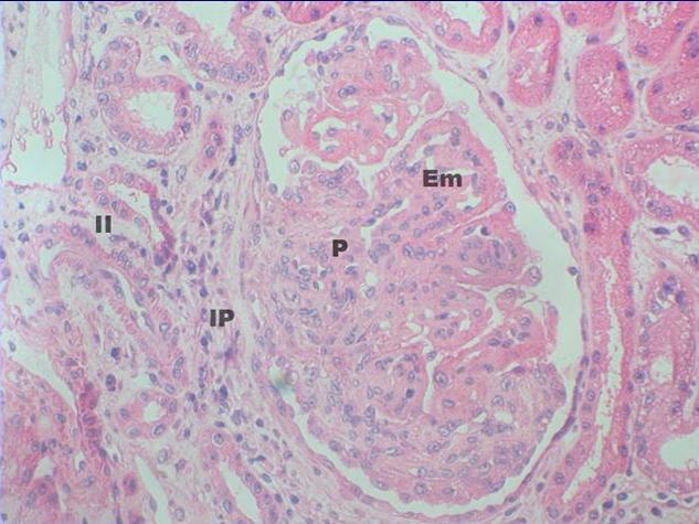 Glomerulonefritis Tipo V C. Plata-Metenamina.400X - <div style=