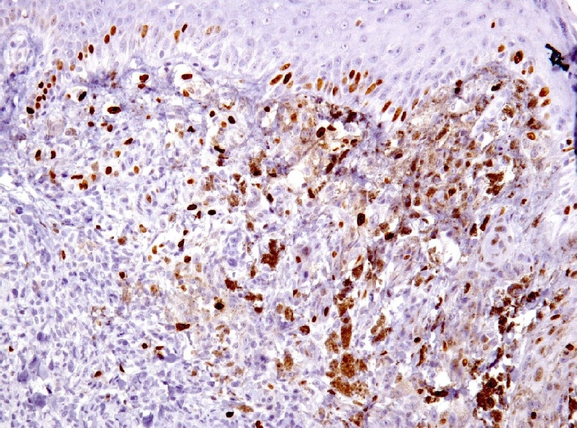 Figura 12 - El Ki67 muestra bajo ndice proliferativo, similar a las clulas del nevus vecino, situado hacia la esquina inferior izquierda de la imagen, teniendo en cuenta de separar la pigmentacin propia de la lesin (Ki 67, 200x).