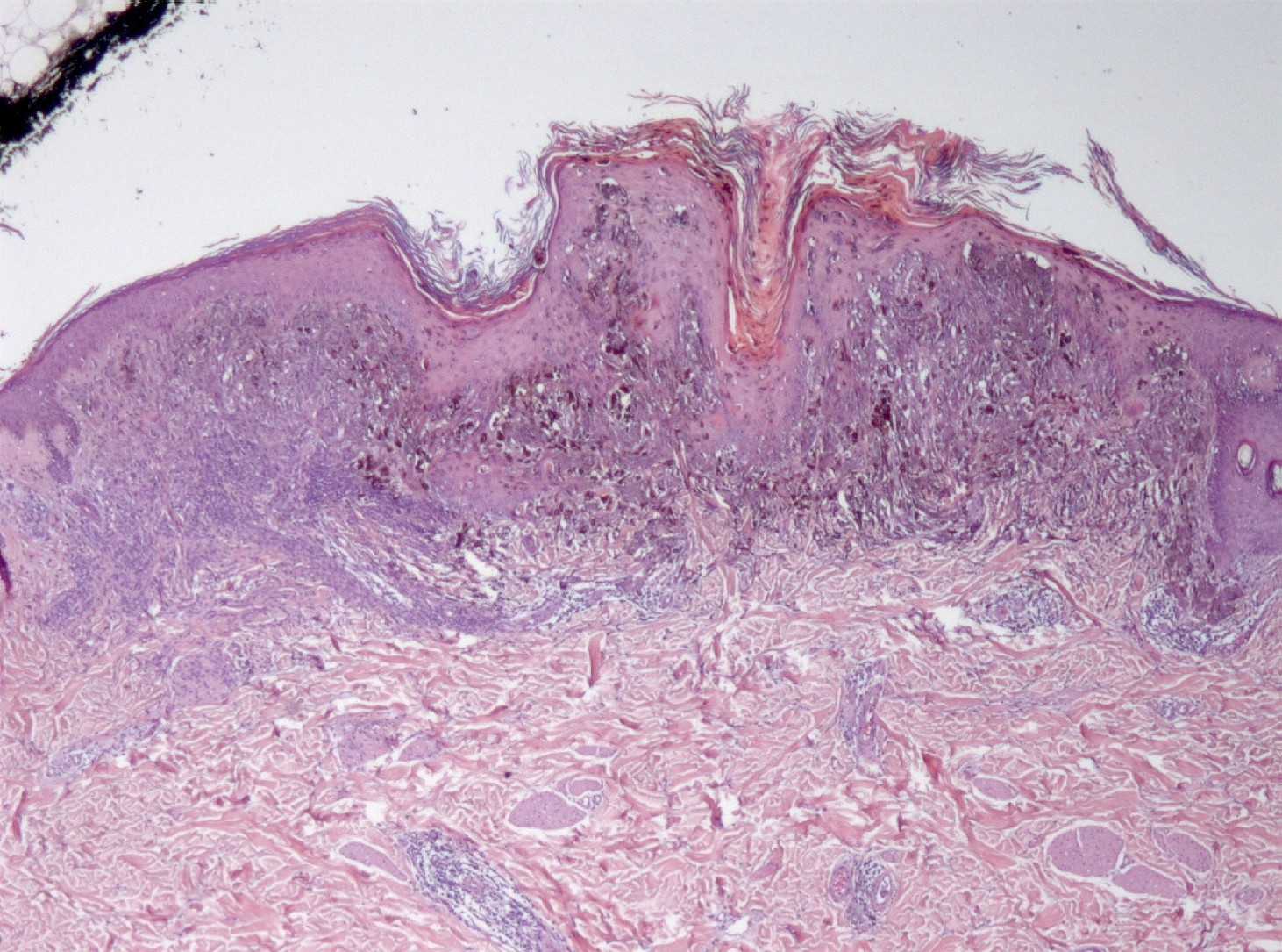 Figura 1 - Imagen panormica de la totalidad de la lesin, con proliferacin celular centrada en la unin dermo-epidrmica, y dermis superior. Se asocia leve hiperplasia epidrmica e inflamacin crnica perivascular (HE, 40x).