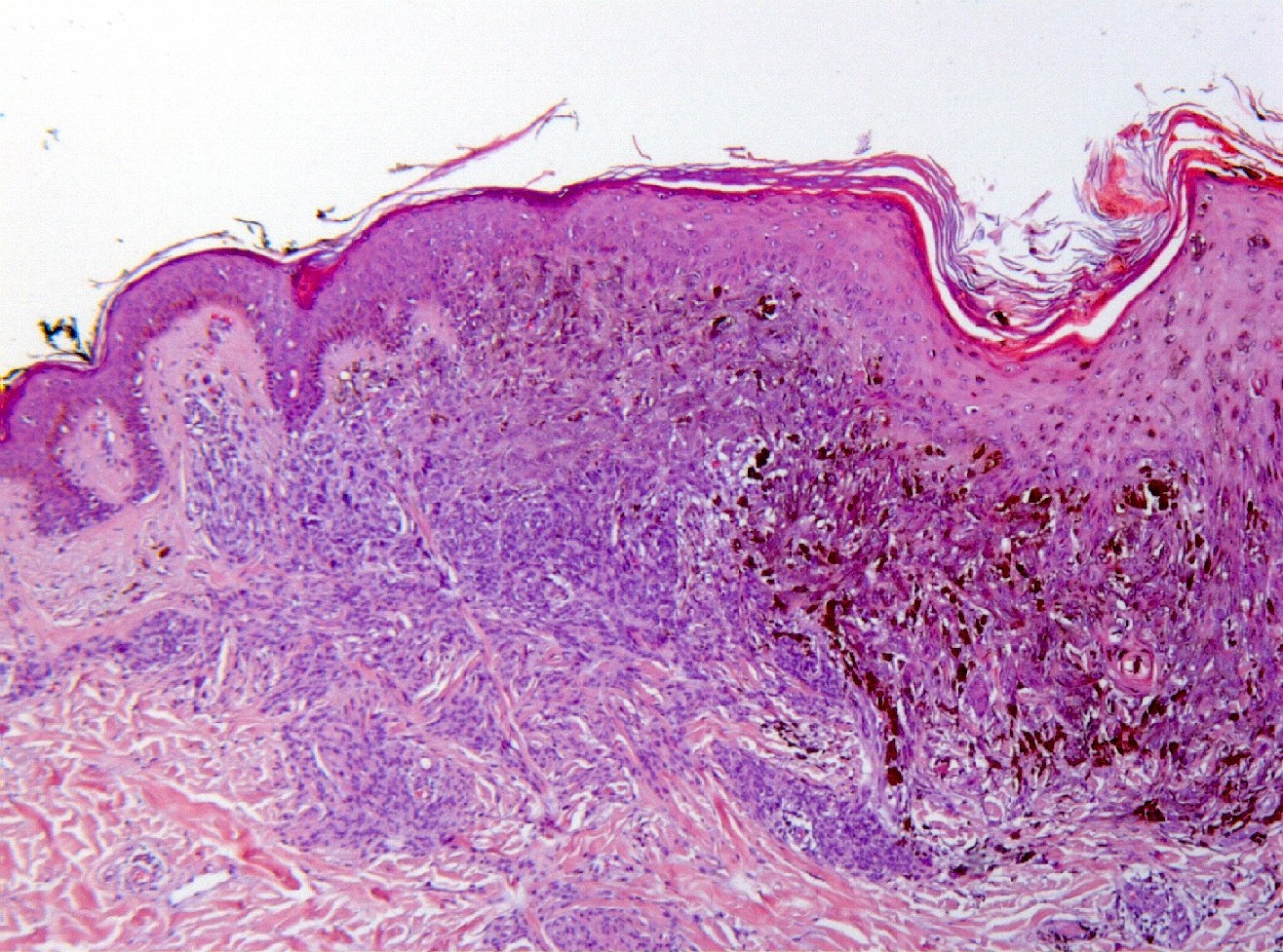 Figura 3 - A uno de los lados se observa la asociacin con un nevus melanoctico convencional (HE, 100x).