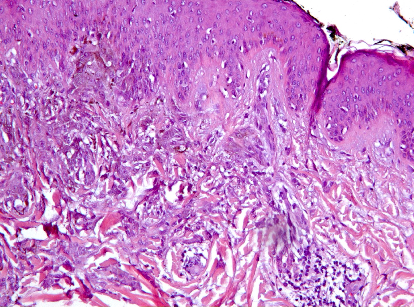 Figura 5 - Margen lateral de la proliferacin donde las clulas se introducen entre los haces de colgeno (HE, 200x).