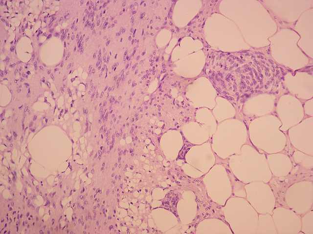Fig.15. Ocasional coleccin de clulas univacuoladas similares a las descritas en la lipofibromatosis.