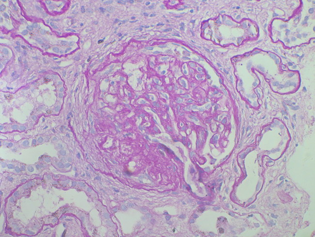 GESF.Rasgos histolgicos. - Glomrulo:Polo hiliar o vascular, luces capilares obliteradas, la estructura del mismo se observa ms afectada con ruptura de la membrana basal e invasin de fibroblastos al interior del mismo.Fibrosis intersticial, dao tubular.PAS 400+.