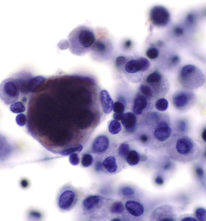 Figura 4: Tincin inmunohistoqumica. Se evidencia tincin citoplsmatica para HMB45 en los grupos celulares, y las clulas del fondo son negativas.(x400)