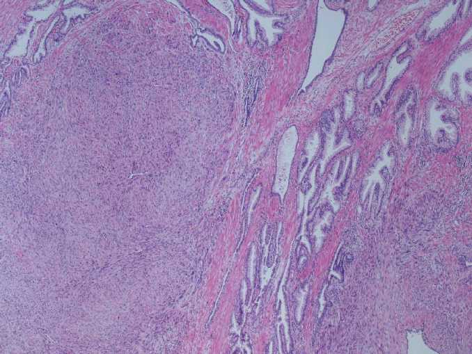 fig6 - caso 2: Panormica de tumoracin fusocelular en la prstata