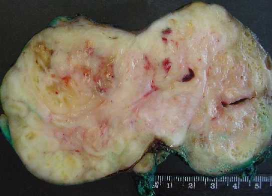 fig1 - caso 1: Tumoracin en la prstata derecha y base que engloba la vescula seminal izda, de color blanquecina con reas de hemorragia