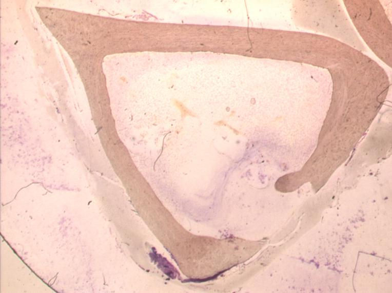 Figura 2. - Imagen panormica del rea zona implantada con focos del material, tejido de granulacin y trabculas neoformadas (H.E. 12.5x).