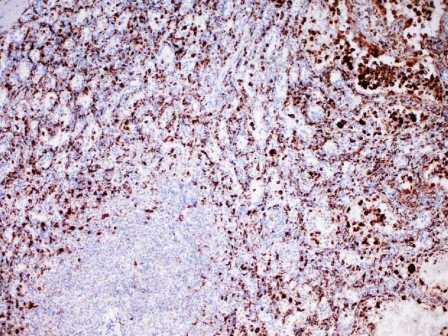 Fig. 5 - Las clulas del hamngioma de clulas litoral son positivas para CD31