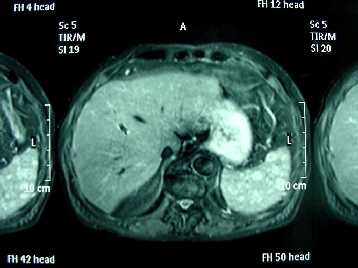Fig. 3 - El hemangioma de clulas litoral radiolgicamente se manifiesta como  mltiplas lesiones de pequeo tamao distribuidas por todo el parnquima