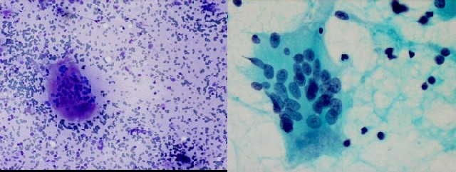 Figura 3. Tiroiditis de De Quervain