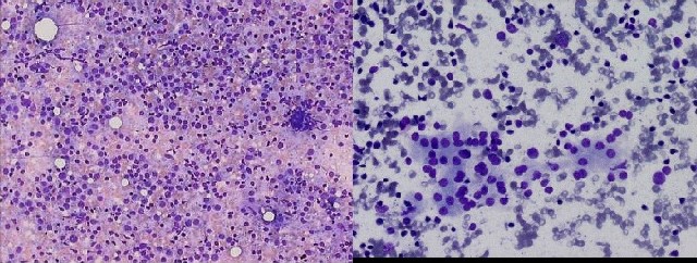 Figura 4. Tiroiditis de Hashimoto