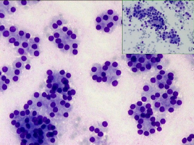 Figura 5. Adenoma folicular y ndulo hiperplsico (recuadro)