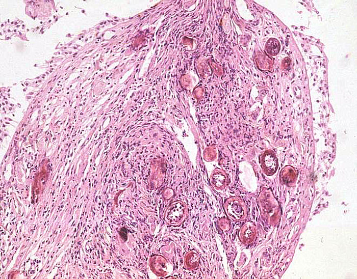 Figura 4.- Biopsia vesical. A nivel de estroma se ven varios huevos de esquistosoma con escasa respuesta inflamatoria (He-Eo x 250).