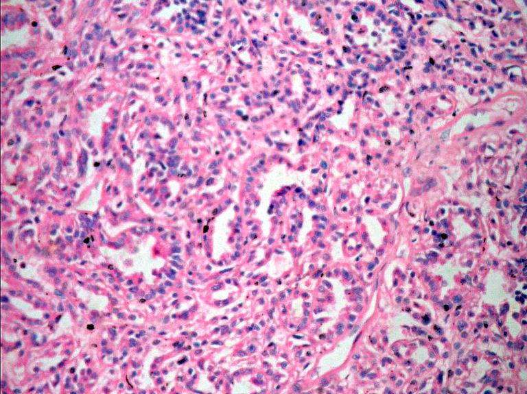 Figura 1. Se observa lesin tumoral maligna de origen epitelial constituida en su totalidad por conductos y estaba separada del tejido renal adyacente por una cpsula fibrosa gruesa.