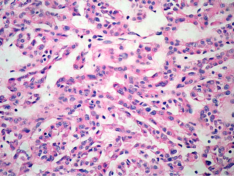 Figura 2. Los conductos de la lesin estn constituidos por clulas de ncleo hipercromatico, aumentado de tamao, con nucleolo eosinfilo prominente, escasas mitosis atpicas y citoplasma eosinofilo intenso de moderada cantidad, que se disponen formando numerosos conductos que semejan conductos colectores distales.