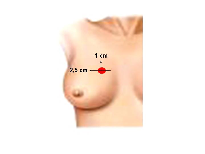 Figura 1 - 
Ndulo, localizado en cuadrante superior interno de mama derecha de 25 x 10 mm por UTS
