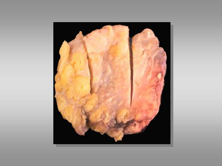 Figura 2 - 
Aspecto macroscpico del ndulo de 2,5 x 1 x   0,8 cm, lobulado con tumor en borde de seccin quirrgica.
