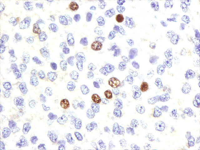 Figura1 - 400x. Expresin de RE por Hepatocarcinoma