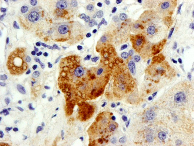 Figura4 - 400x. Expresin de ApoD por Hepatocarcinoma