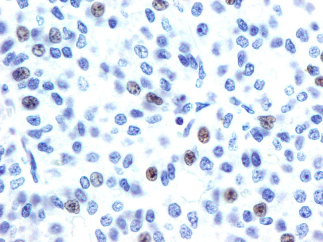 Figura 2 - 400x. Expresin de RP por Hepatocarcinoma