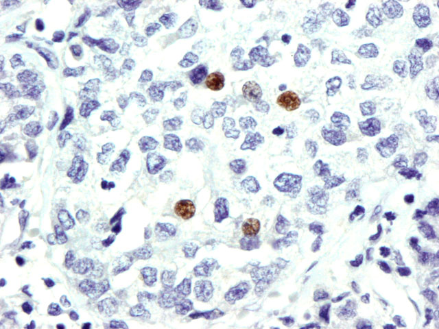 Figura3 - 400x. Expresin de RA por Hepatocarcinoma