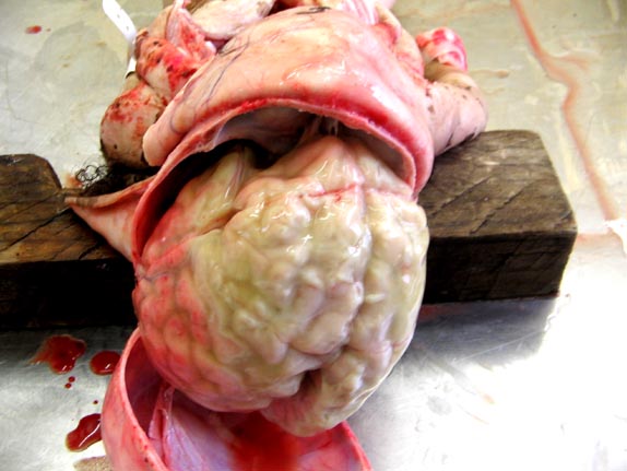 meningitis