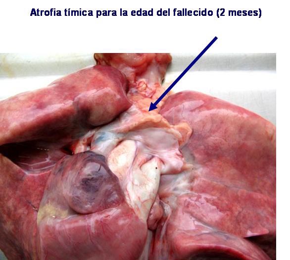 Figura 5: Atrofia tmica encontrada macroscpicamente. Los pulmones muestran congestion. El lbulo superior derecho mostr inflamacion supurativa no visible en la foto (parte posterior).