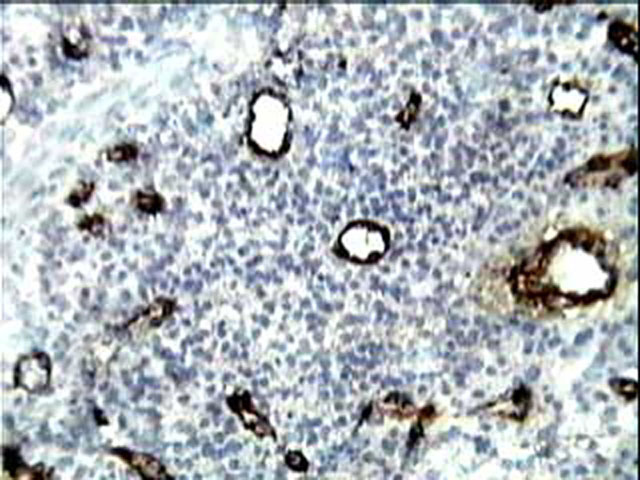 Figura 2. Carcinoma Epidermoide de Cabeza y Cuello. Note la localizacin intratumoral de los microvasos. Inmunomarcaje con el Factor VIII. 100X.