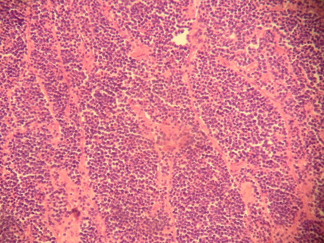 Fig. 5. - Septos fibrovasculares, resultan en compartimientos neoplasicos