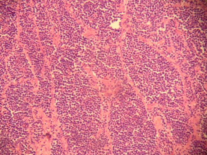 Fig. 5. - Septos fibrovasculares, resultan en compartimientos neoplasicos