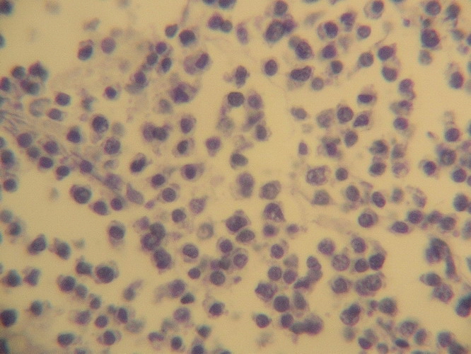 Fig. 19. AE1/AE3 - El coctel para citoqueratinas de amplio espectro AE1/AE3 es negativo, en las clulas tumorales.