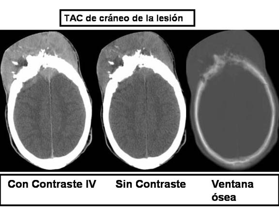 Figura 1: Tumor de partes blandas de gran tamao, localizado fuera del crneo en la regin frontal, midiendo 99x47mm con destruccin sea por debajo del mismo. La imagen de la derecha muestra una extensin intracraneal de 64x17x50mm. El tejido cerebral y sistema ventricular se encuentran conservados. No se observan efectos de compresin.

