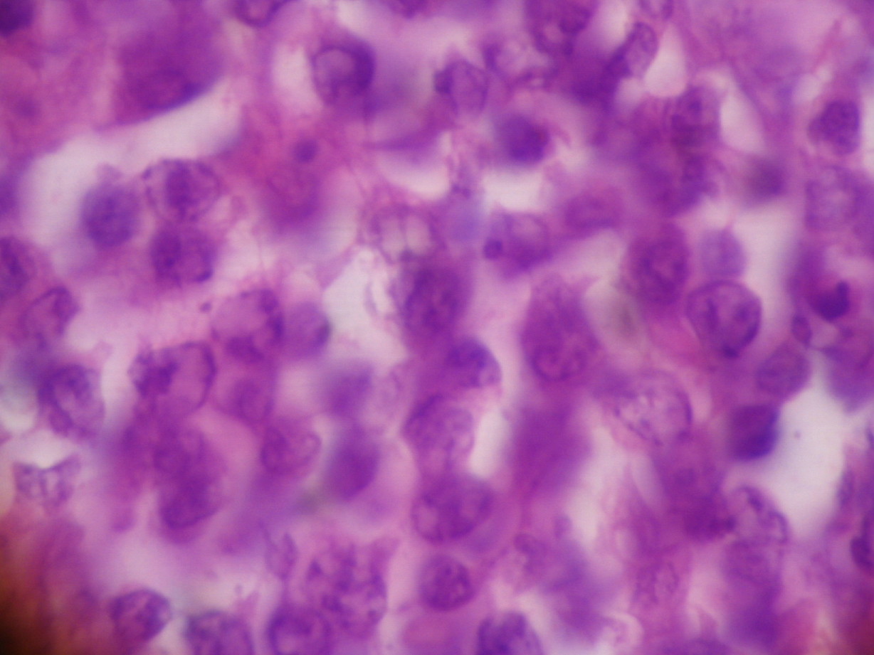 Imagen 8 - a mayor aumento ya se poda ver que las clulas no eran tan pequeas sino grandes, de ncleo ovalado a redondo, vesiculoso, el doble de tamao de un linfocito pequeo, de cromatina laxa, nuclolo central prominente; y seguan siendo azules y francamente linfocitoides, hendidas y no hendidas, semejando centroblastos o inmunoblastos, tambin estaban presentes clulas aun mayores que recordaban clulas del linfoma anaplstico de clulas grandes
