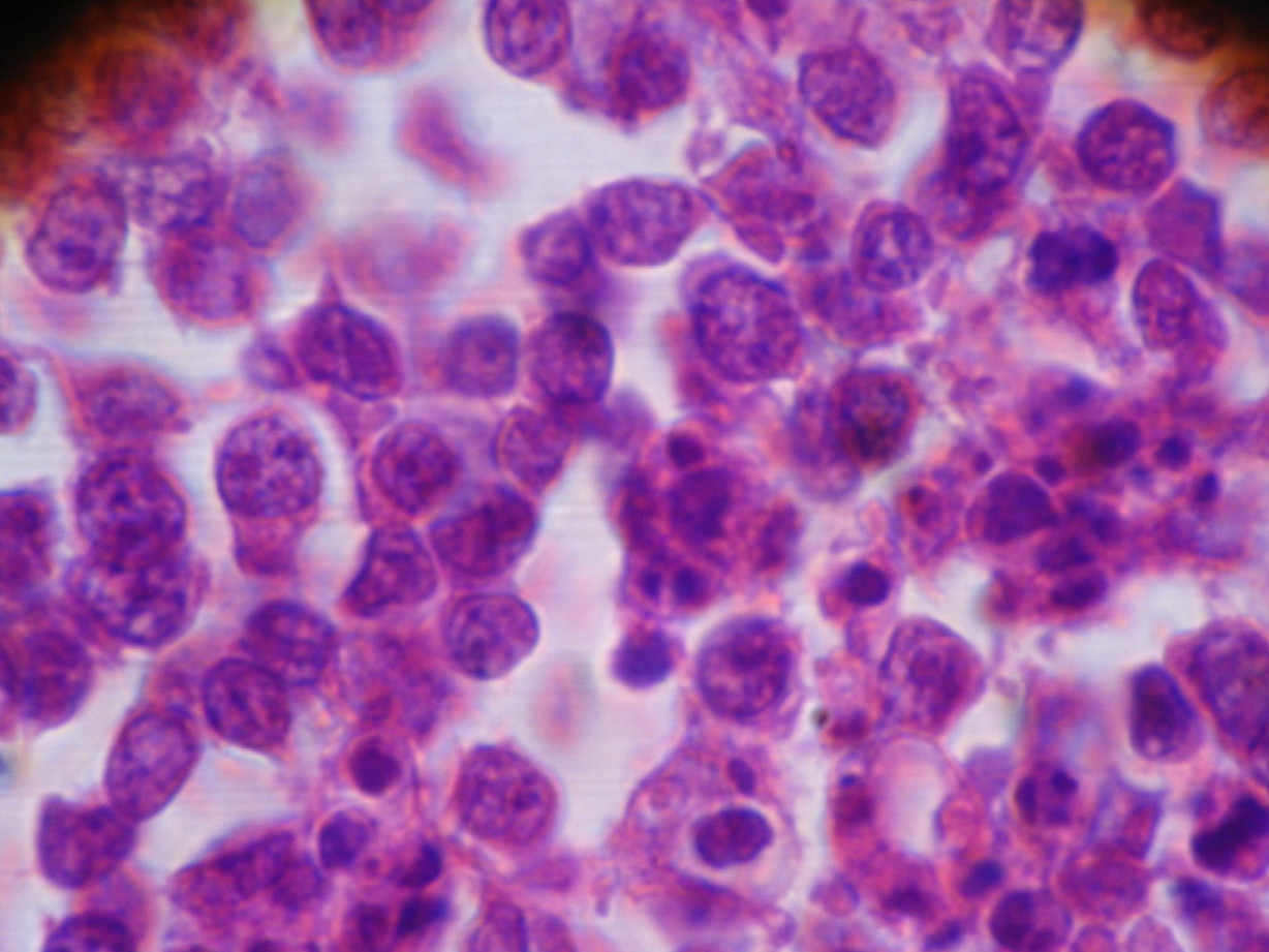 Imagen 9 - a mayor aumento ya se poda ver que las clulas no eran tan pequeas sino grandes, de ncleo ovalado a redondo, vesiculoso, el doble de tamao de un linfocito pequeo, de cromatina laxa, nuclolo central prominente; y seguan siendo azules y francamente linfocitoides, hendidas y no hendidas, semejando centroblastos o inmunoblastos, tambin estaban presentes clulas aun mayores que recordaban clulas del linfoma anaplstico de clulas grandes