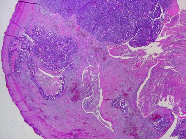 Foto a bajo aumento: Tumoracin polipoide endoluminal, confinada a la trompa
