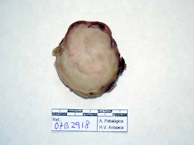 Foto macroscpica: tumor nodular slido fascicular con presencia en porcin superior de rin.