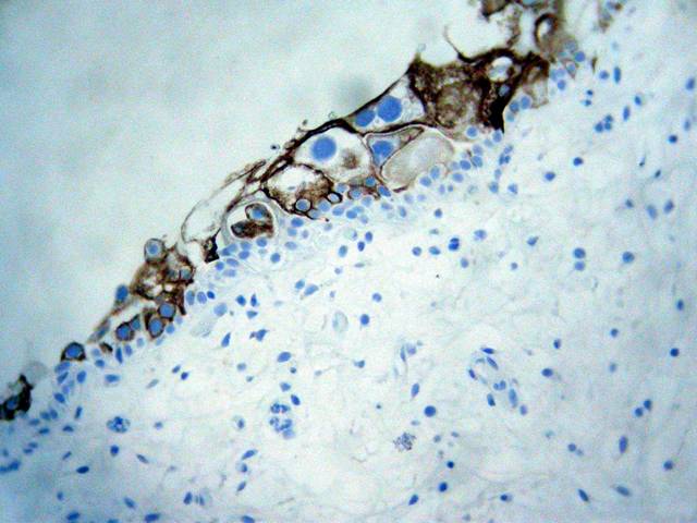 Figura 4 - Tincin de membrana citoplsmica para citoqueratina 20.