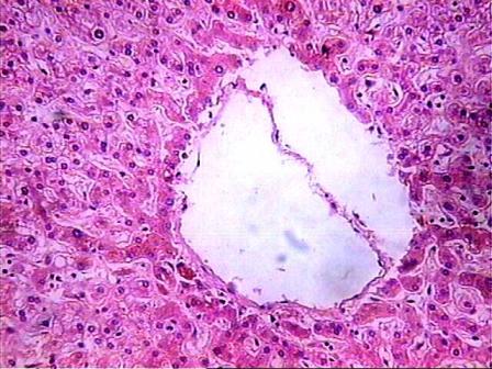 No. 4 - Se observa congestin heptica