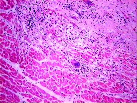 No. 5 - Se observa infiltrado inflamatorio mononuclear rico en linfocitos y algunos histiocitos, hay perdida extensa del tejido muscular y clulas gigantes multinucleadas