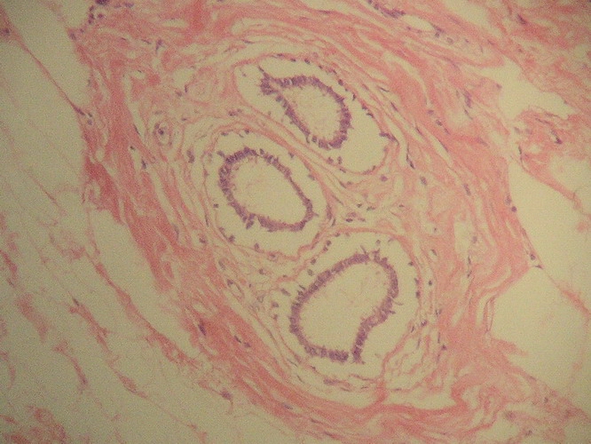 Fig. 4 - Sector alejado del tumor original, con estructuras de dificultosa interpretacin: Si corresponde a Linfangitis carcinomatosa mostrando estructuras papilares rodeando espacios vacios, o si corresponde a focos de tumor a distancia del original.