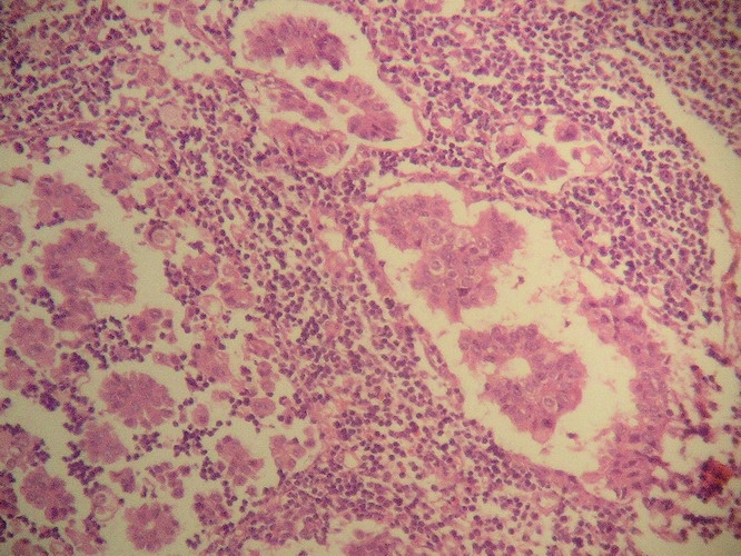 Fig. 16 - Metastasis ganglionar linftica con patrn micropapilar.