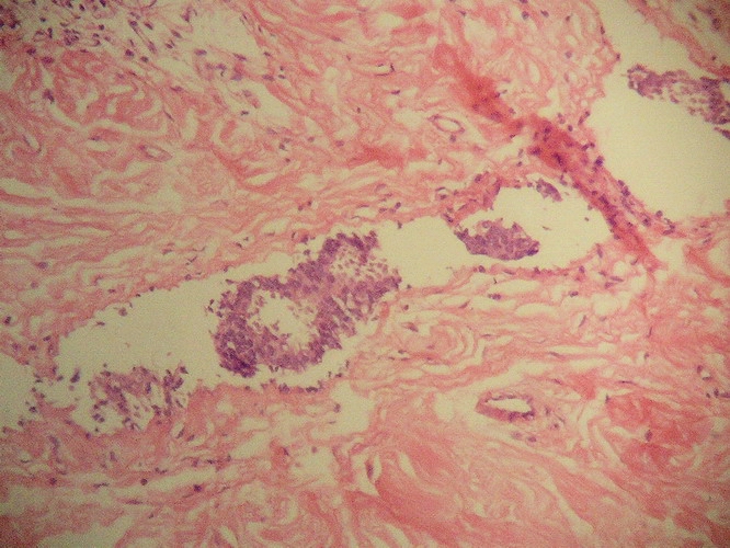 Fig. 5 - Pieza de mastectoma. Linfangitis carcinomatosa.
