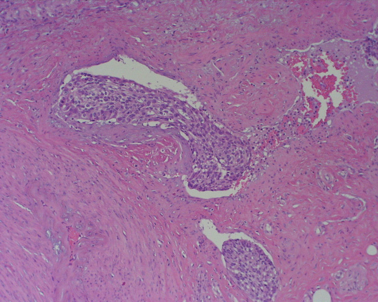 Figura 3 - Imgen histolgica de pene,con extensas areas de invasin vascular en cuerpo cavernoso (Priapismo)(hematoxilina-eosina)