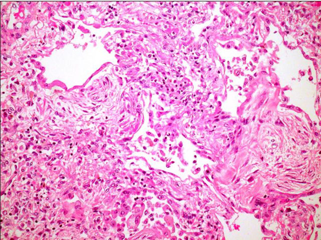 Dao alveolar difuso en fase proliferativa - <div style=