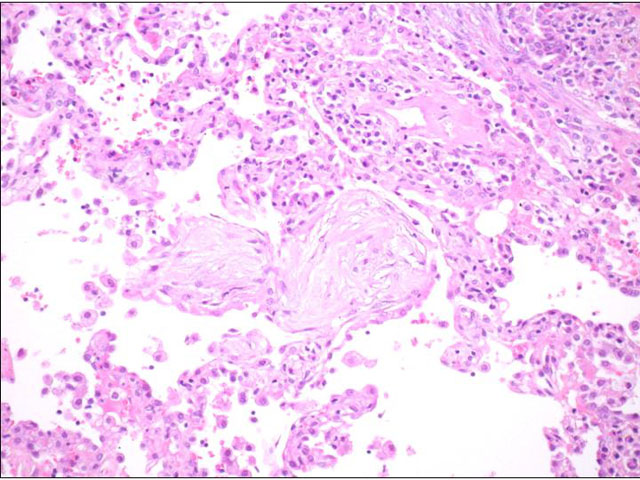 Neumona organiza criptognica - <div style=